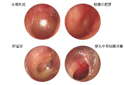 2,鼻甲肥大,鼻息肉,鼻咽部肿瘤,增殖体肥大等,压迫咽鼓管造成